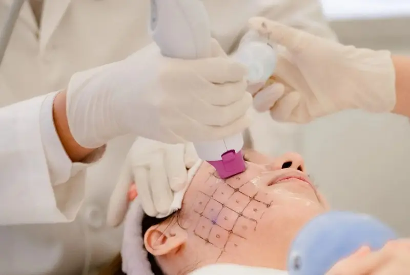 Thermage giúp nâng cơ khắc phục làn da chảy xệ