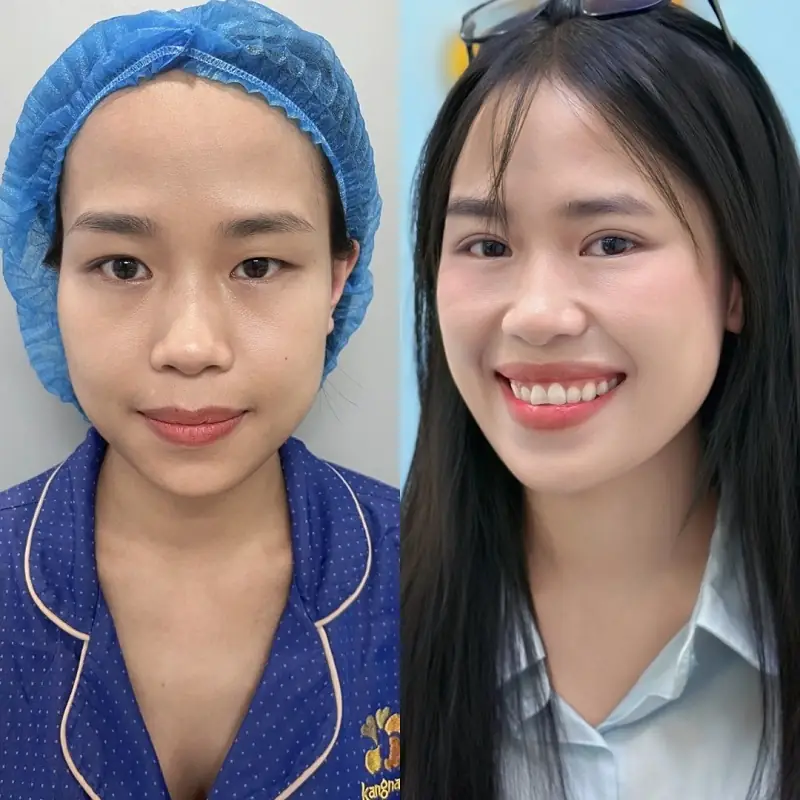 Sự thay đổi ngoạn mục của khách hàng Thanh Trang sau 7 ngày: Mắt to tròn, nếp mí sắc nét và góc mắt mở rộng tự nhiên.