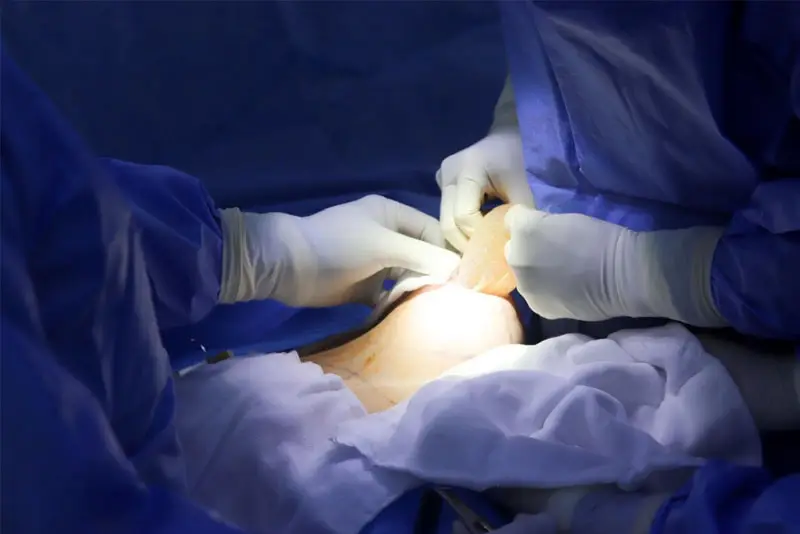 Tháo túi ngực cần bác sĩ chuyên môn cao