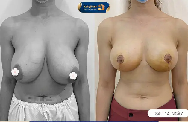 Treo sa trễ kết hợp nâng ngực