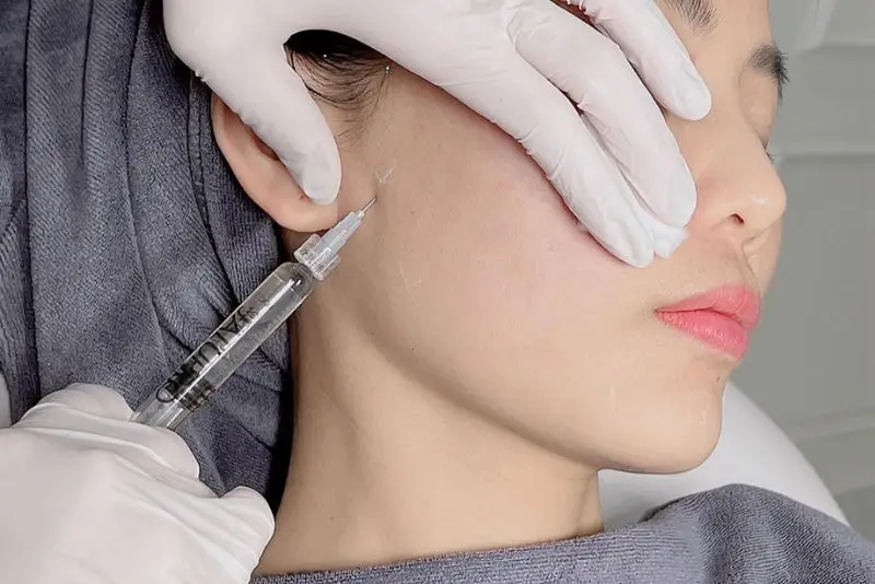 BAP Profhilo thực hiện tiêm tại năm điểm cố định