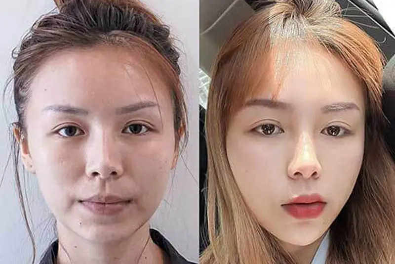 Tiêm botox thon gọn có chi phí dao động từ 4.500.000 - 10.000.000 VNĐ