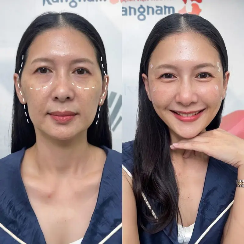 Chọn tiêm filler tại cơ sở uy tín