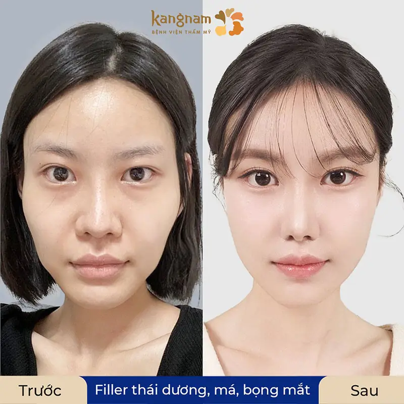 Filler ổn định sau 1 tuần