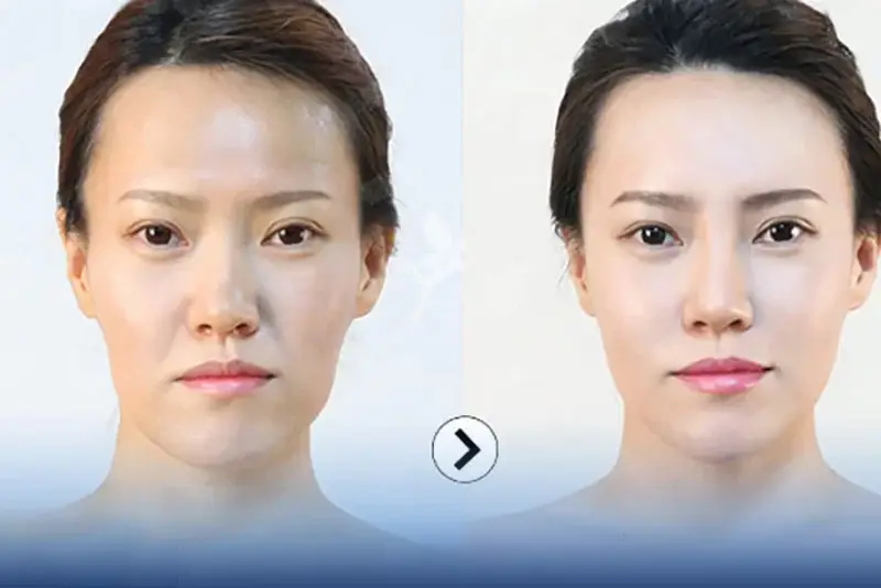 Tiêm filler rãnh cười là phương pháp làm đẹp không phẫu thuật