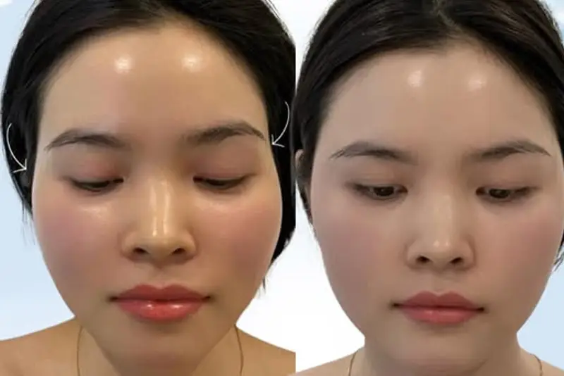 Tiêm đầy thái dương bao nhiêu tiền tùy thuộc vào loại filler và liều lượng tiêm