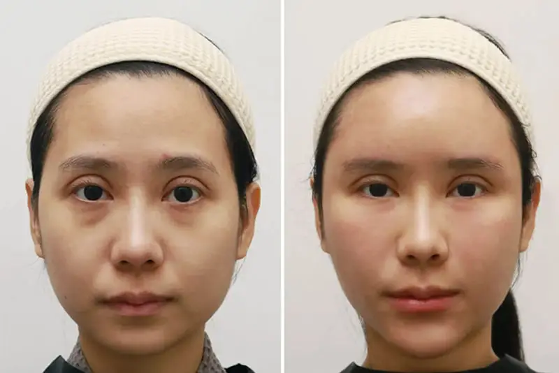 Sau khi tiêm tan mỡ, khuôn mặt thon gọn, nữ tính