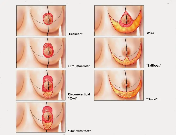 Treo ngực sa trễ không đặt túi giá bao nhiêu