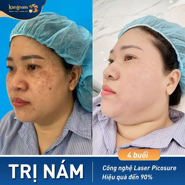 Khách hàng thực tế điều trị nám tại Kangnam