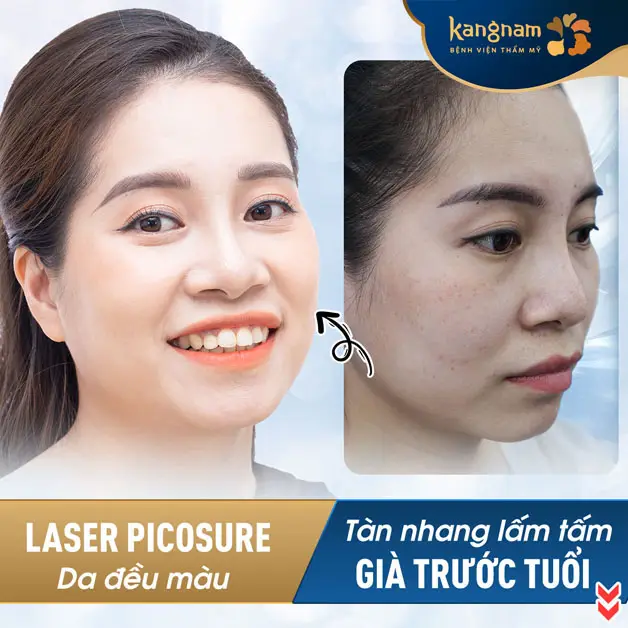 Sau liệu trình điều trị bằng laser Picosure, làn da trở nên sáng khỏe hơn