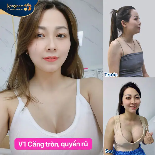 Vòng 1 căng tròn sau phẫu thuật