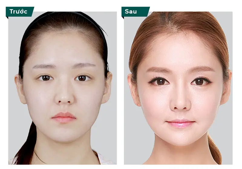 Trượt cằm khắc phục triệt để tình trạng cằm ngắn, cằm lẹm