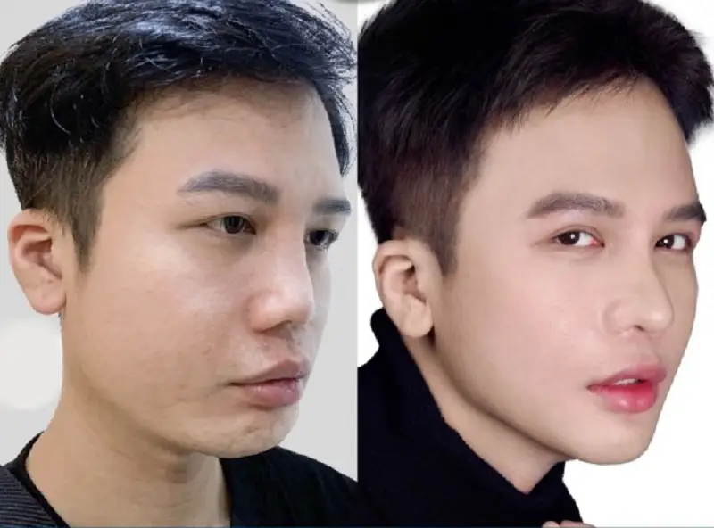 Tuân thủ hướng dẫn chăm sóc của bác sĩ giúp vết thương sau trượt cằm nhanh lành