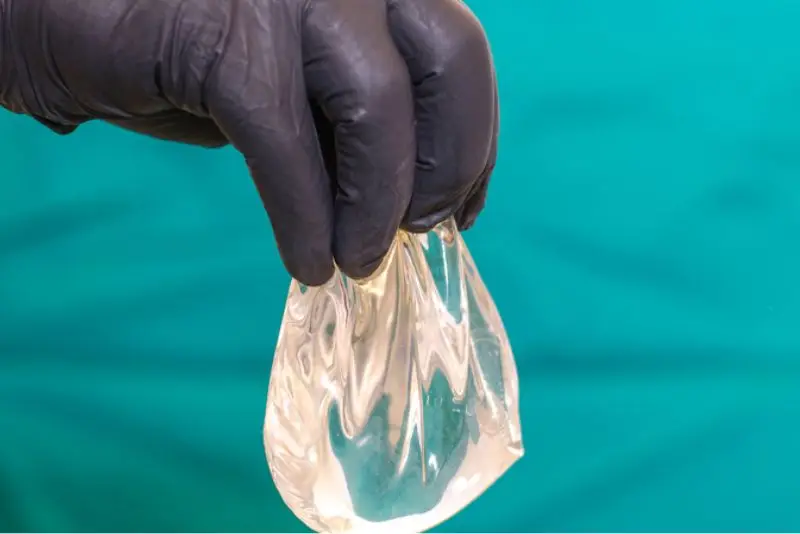 Túi ngực biến dạng là dấu hiệu cần thay