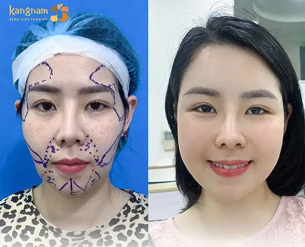 Cấy mỡ tự thân có độ tương thích cao với cơ thể, an toàn, không lo đào thải