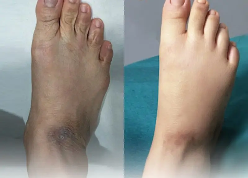 Vùng cấy mỡ sau khi ổn định sẽ mềm mại và tự nhiên