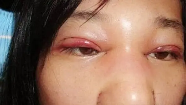 Cắt mí sau sưng do chăm sóc hậu phẫu không đúng cách 