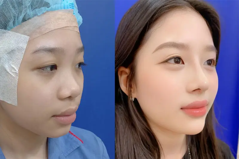 Kết quả nâng mũi sụn tai ổn định, đẹp tự nhiên