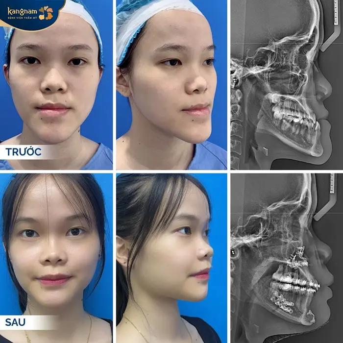 Trượt cằm cải thiện diện mạo khuôn mặt, khắc phục các khuyết điểm như cằm ngắn, cằm lẹm hoàn hảo 