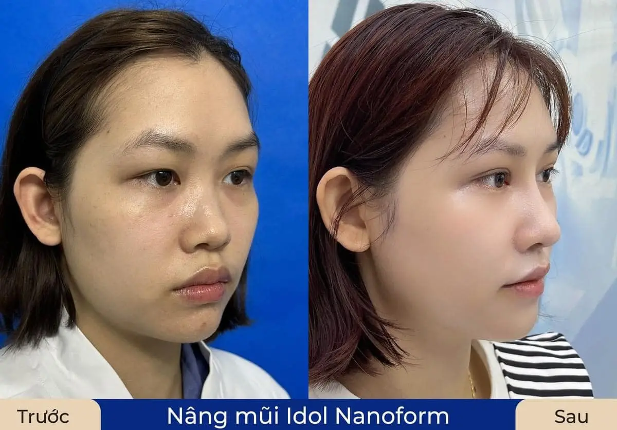 Dáng mũi tự nhiên, hài hòa sau khi vào form