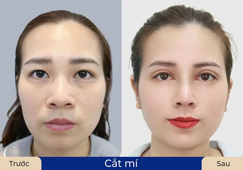 Nếp mí hài hòa, cân đối với gương mặt