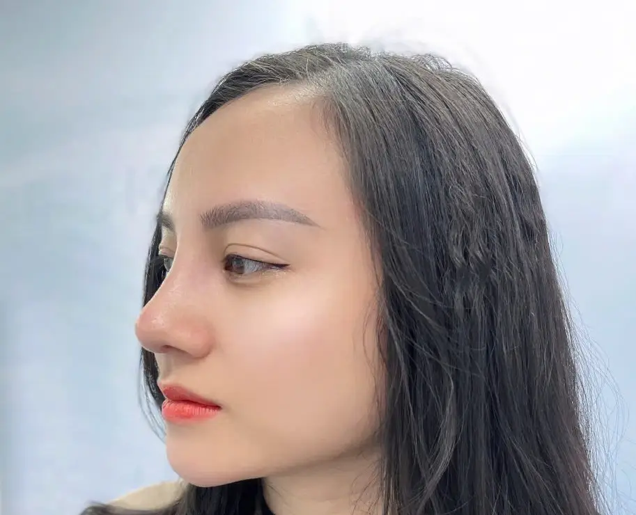 Dáng mũi sau khi nâng mũi nhân tạo 10 ngày