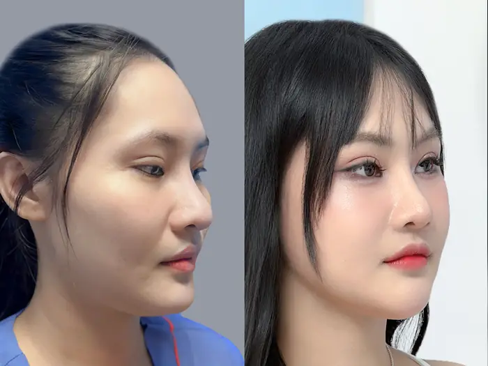 khách hàng trước và sau khi hạ gò má tại Kangnam, tình trạng gò má cao khiến gương mặt già nua nên hạ gò má