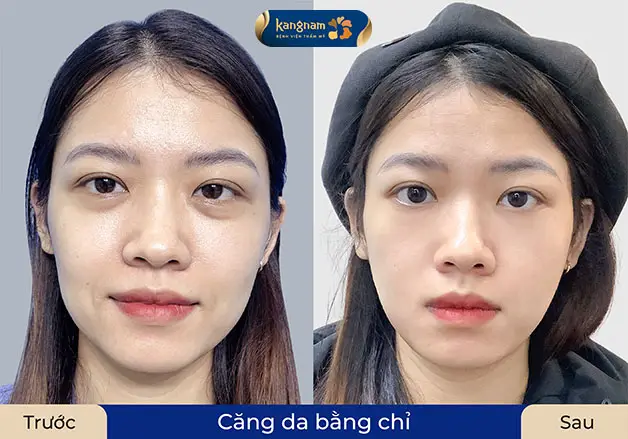 Căng da bằng chỉ