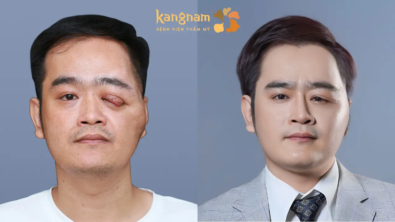 Nguyễn Thanh Hưng là trường hợp được TS.BS Richard Huy phẫu thuật cắt mí