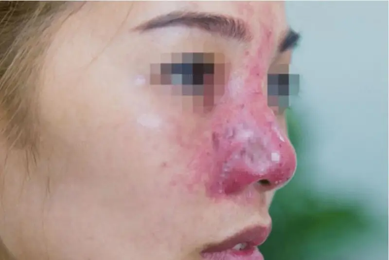 Mũi bị hoại tử do tiêm filler không chuẩn