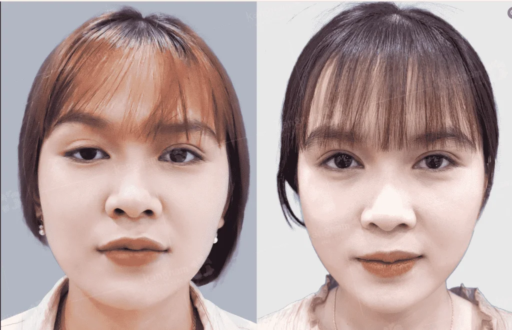 Cắt mí giúp 2 nếp mí rõ nét, đều nhau hơn