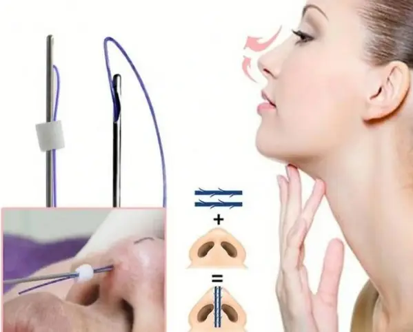 Nâng mũi bằng chỉ là phương pháp sử dụng chỉ collagen hoặc chỉ sinh học để kéo và định hình dáng mũi