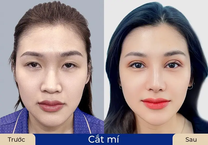 Khách hàng sở hữu đôi mắt 2 mí cân đối, to tròn
