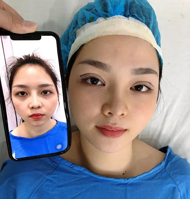 Chi phí nhấn mí tại Kangnam đã bao gồm trọn gói thăm khám, nhấn mí, chăm sóc sau nhấn mí