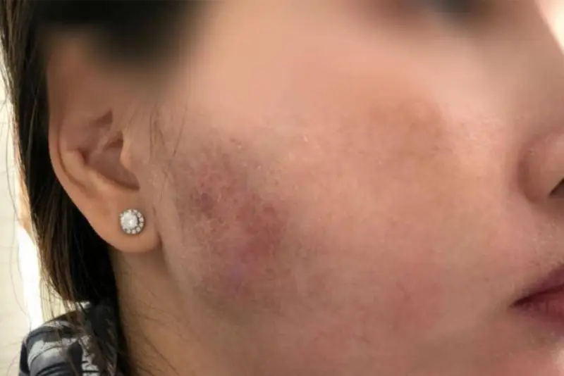 Vùng má vón cục, sưng bầm sau tiêm filler