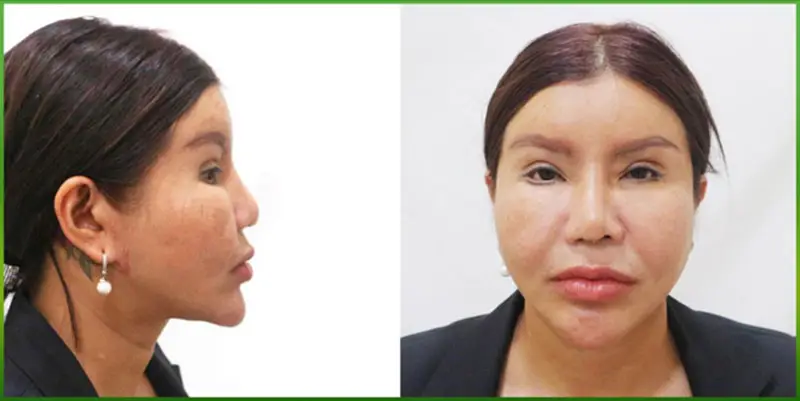 Mũi biến dạng khi về già do bác sĩ thực hiện sai kỹ thuật