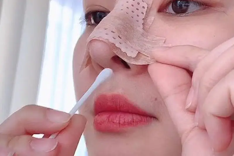 Sau khi cắt chỉ nâng mũi cần dành thời gian nghỉ ngơi, hạn chế vận động mạnh