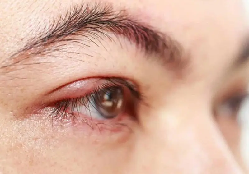 Có thể trị sẹo lồi ở góc mắt bằng phương pháp laser, phẫu thuật