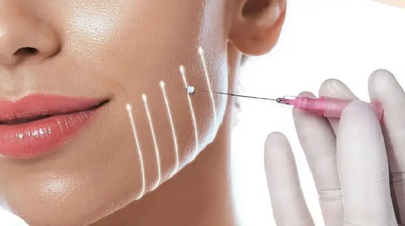 Căng chỉ collagen gold fiber giúp làn da đàn hồi tốt hơn