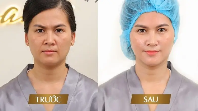 Làn da căng mịn, giảm thiểu nếp nhăn sau khi căng chỉ