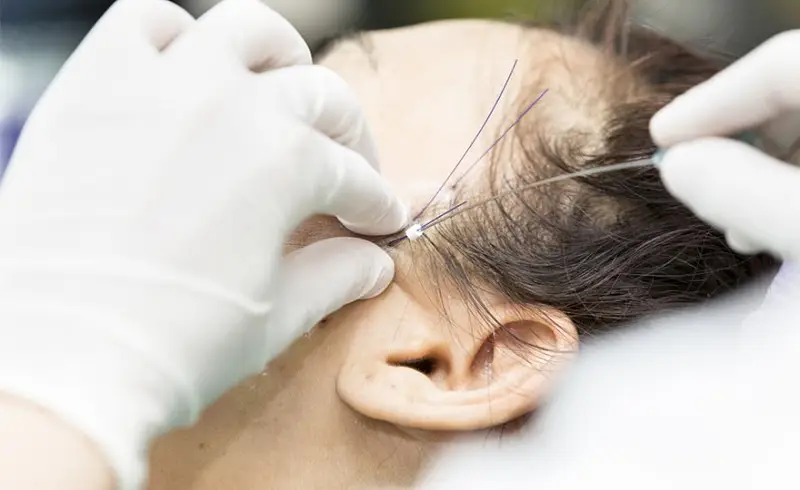 Căng chỉ mặt được thực hiện đúng kỹ thuật sẽ không gây ra tác dụng phụ lâu dài