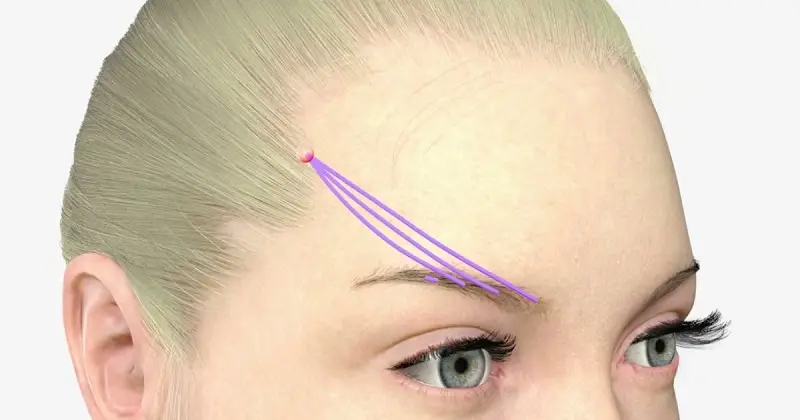 Phẫu thuật căng da thái dương duy trì hiệu quả lâu dài