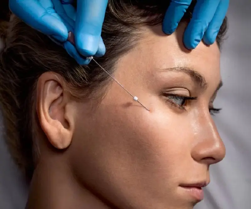 Căng chỉ thái dương sử dụng chỉ để nâng đỡ, ngăn ngừa tình trạng da chảy xệ