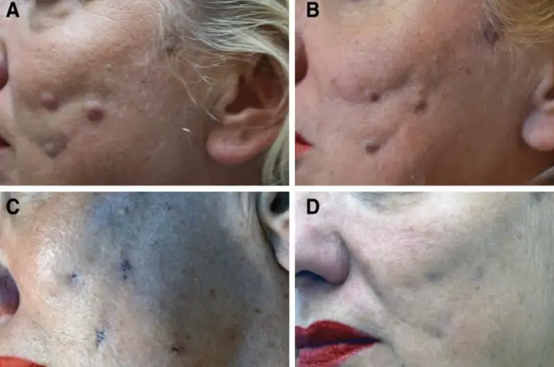 Căng da mặt bằng chỉ có thể rảy ra biến chứng tụ máu, nhiễm trùng, mất mô nếu như không được thực hiện tại địa chỉ thẩm mỹ uy tín