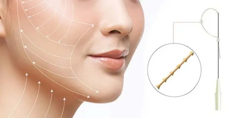 Tùy thuộc vào từng phương pháp căng da mặt sẽ có chi phí khác nhau