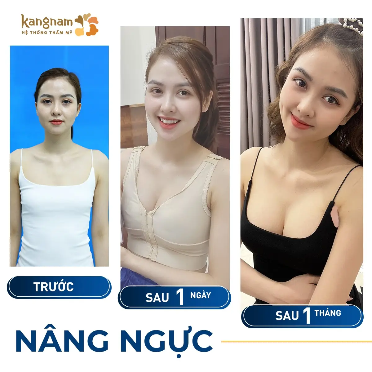 quá trình nâng ngực của Hot mom Huyền Giang trước và sau sinh, vòng 1 đầy đặn quyến rũ