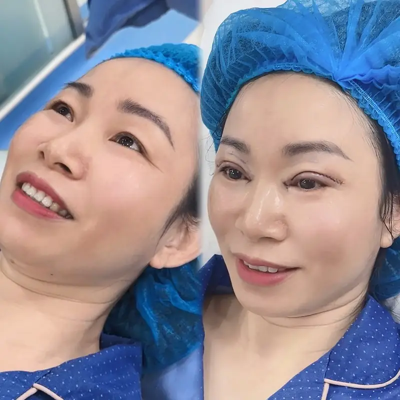 Cắt da thừa mí mắt khắc phục tình trạng da chùng nhão, chảy xệ