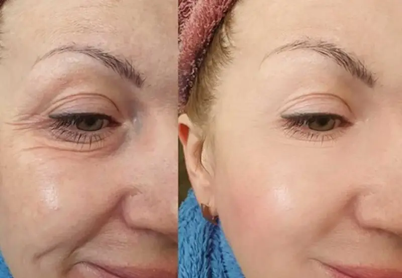 Chi phí cắt da thừa mí mắt dưới làm cho đôi mắt trẻ hơn