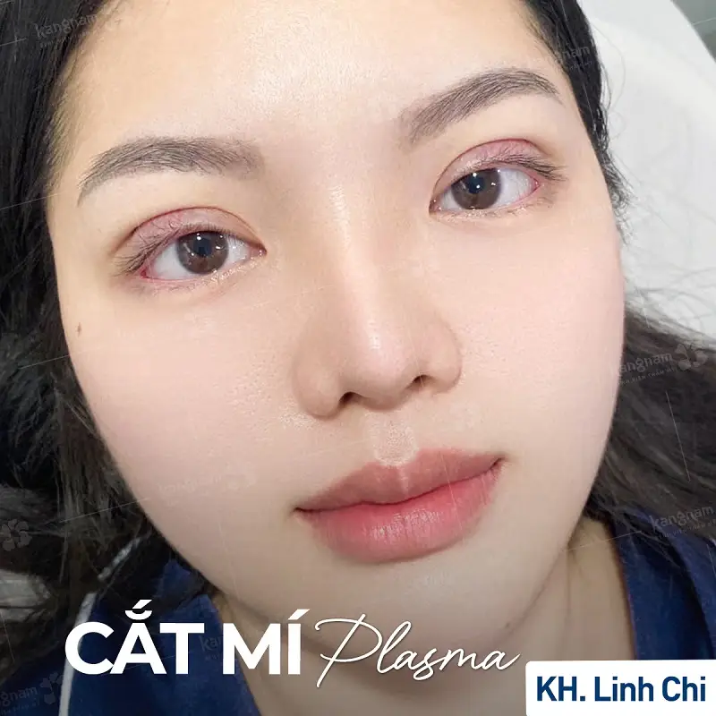 Những kỹ thuật cắt mí tiên tiến, sẽ giúp giảm thiểu tổn thương và rủi ro cho mí mắt