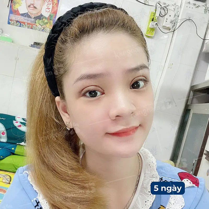 Chăm sóc tốt giúp mí ổn định